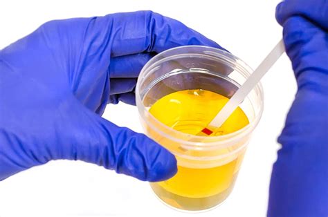 torn seal on urinalysis test|what is a urinalysis test.